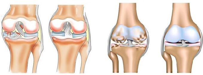 What is arthritis and arthrosis